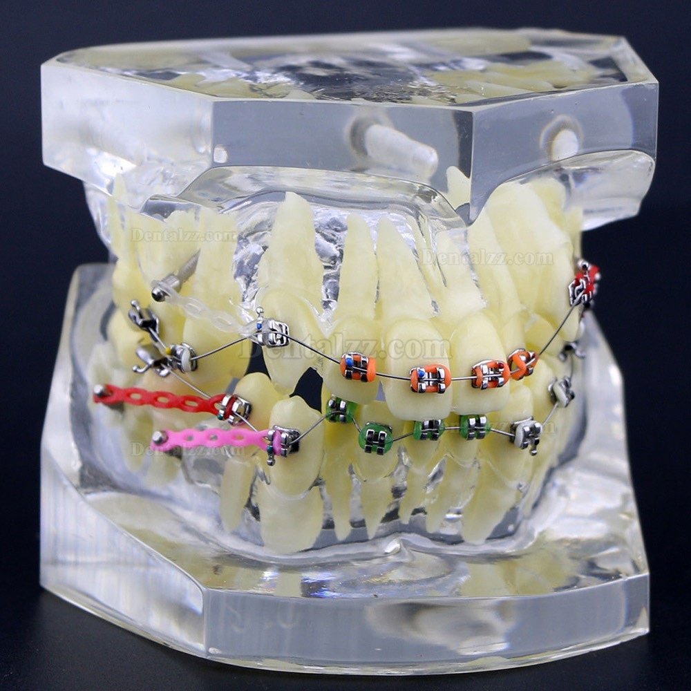歯列矯正モデル 模型 矯正治療説明用モデル 金属ブラケット ワイヤーチェーン付き クリア